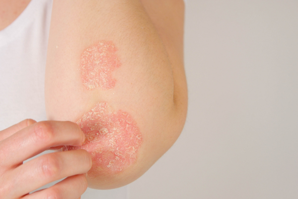 Psoriasis Treatment in Pimpri Chinchwad, Pune | Dr. Gauri Padmawar